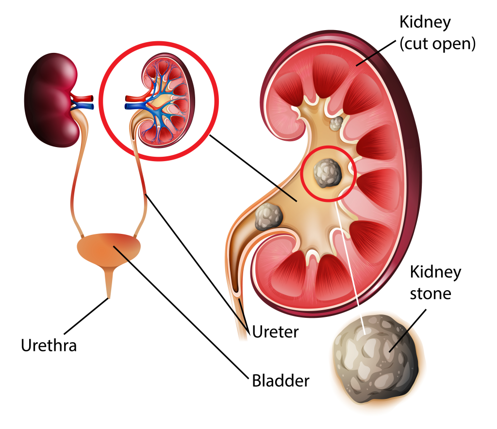 Kidney Stones